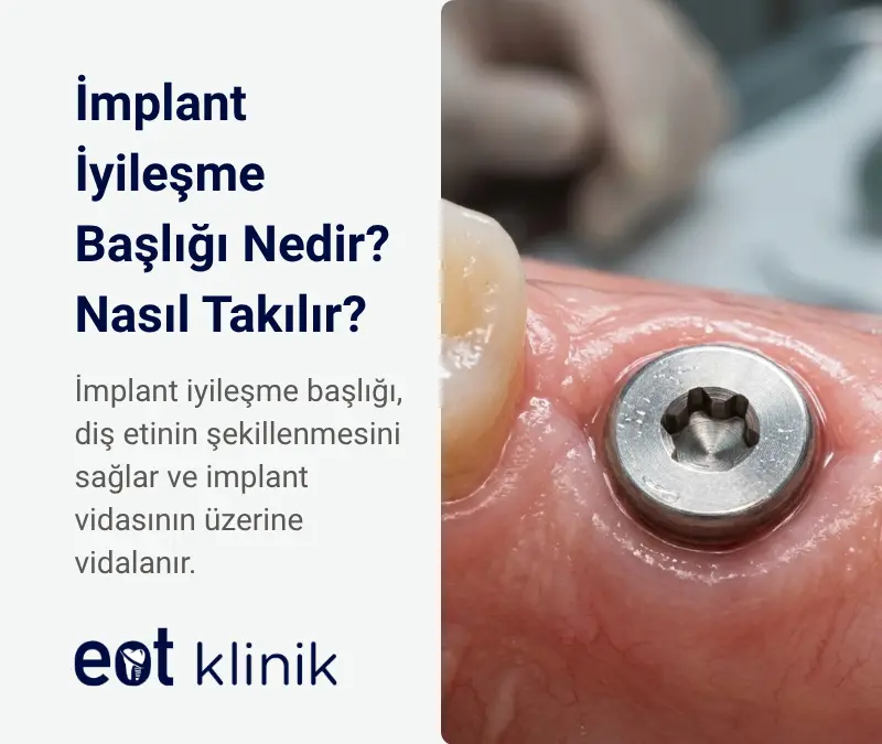 İmplant İyileşme Başlığı Nedir? Nasıl Takılır, Sallanırsa ve Düşerse Ne Olur?