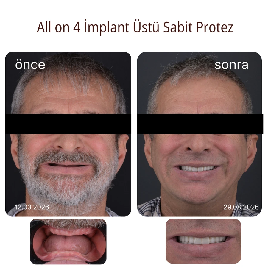 All-on-4 implant-supported fixed prosthesis before and after