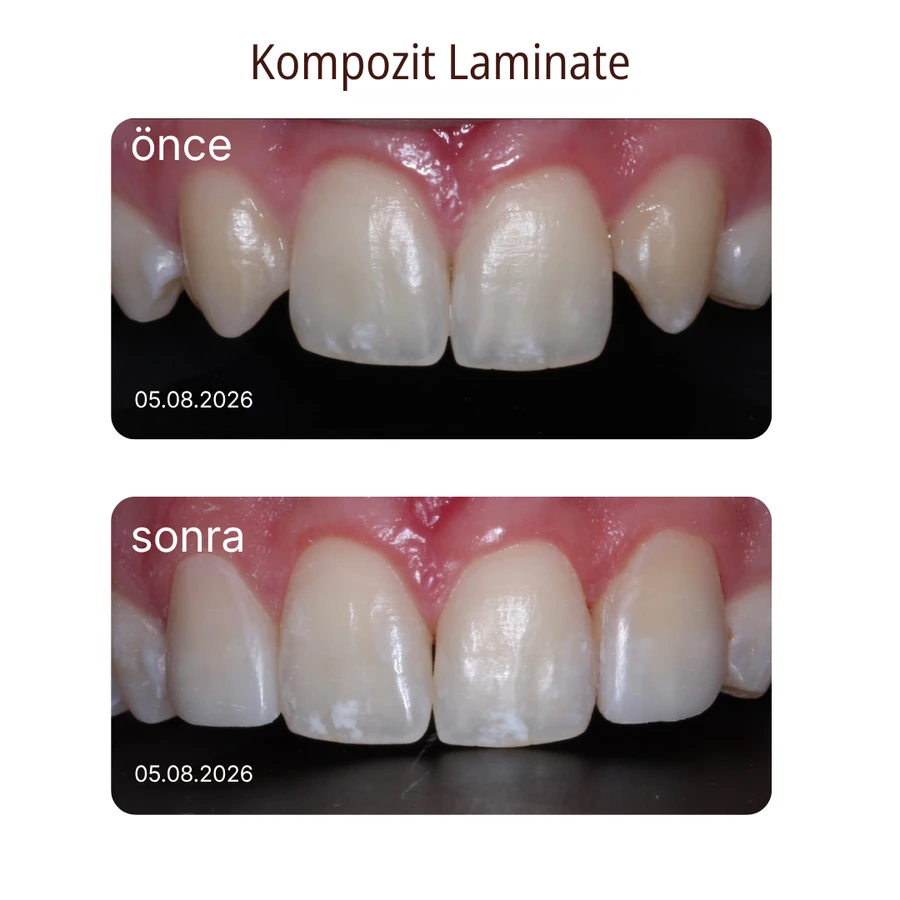 Composite laminate before and after
