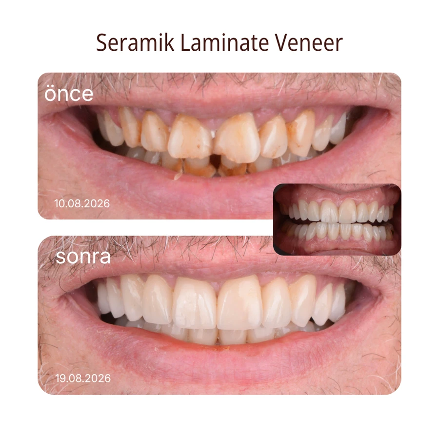 Ceramic laminate veneers before and after