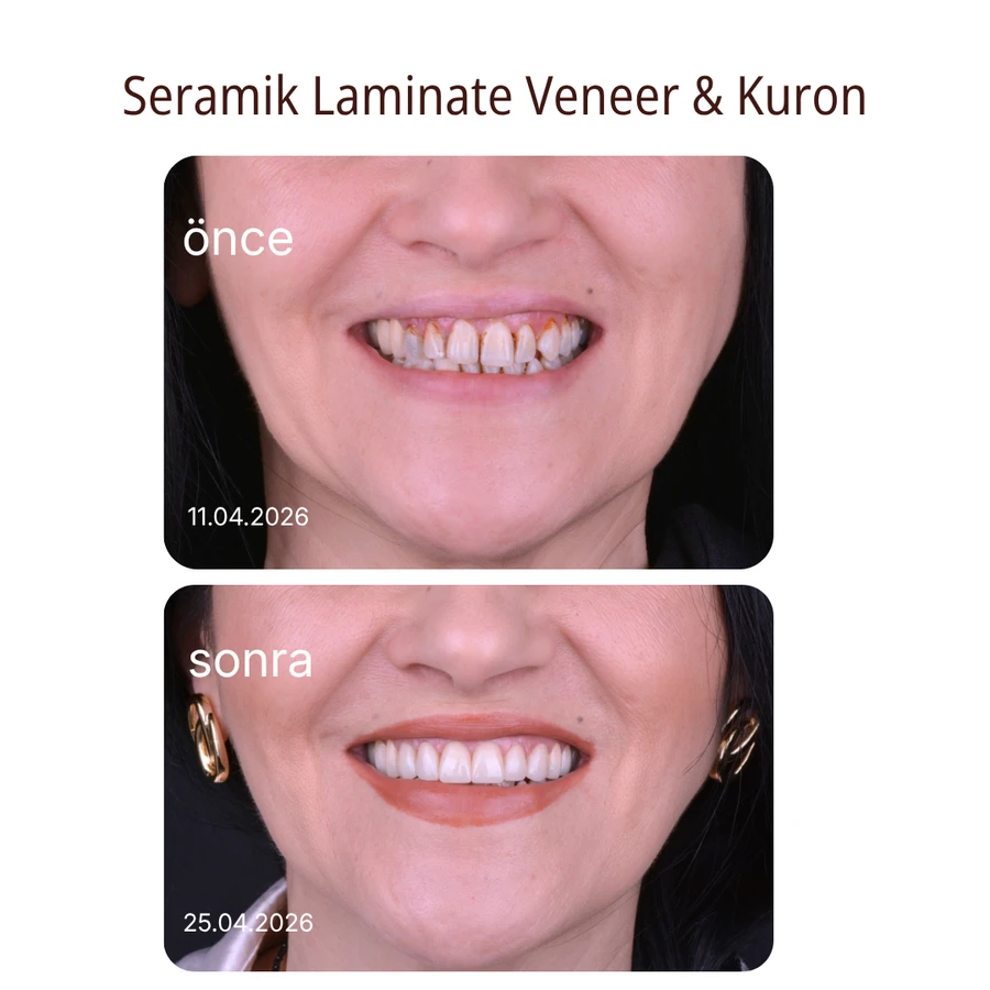 Ceramic laminate veneers and crowns before and after