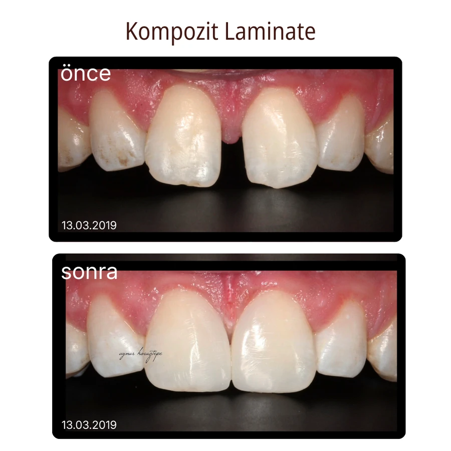 Komposit-Laminat-Veneer Vorher-Nachher Fall 9