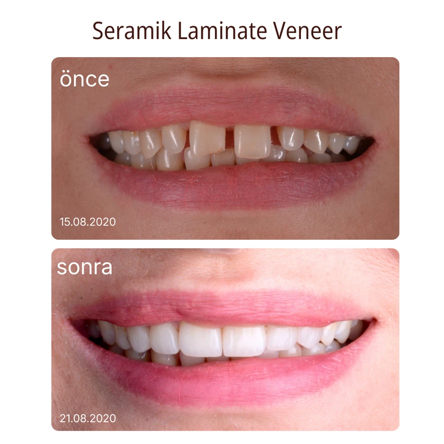 Keramik-Laminat-Veneer Vorher-Nachher Fall 5