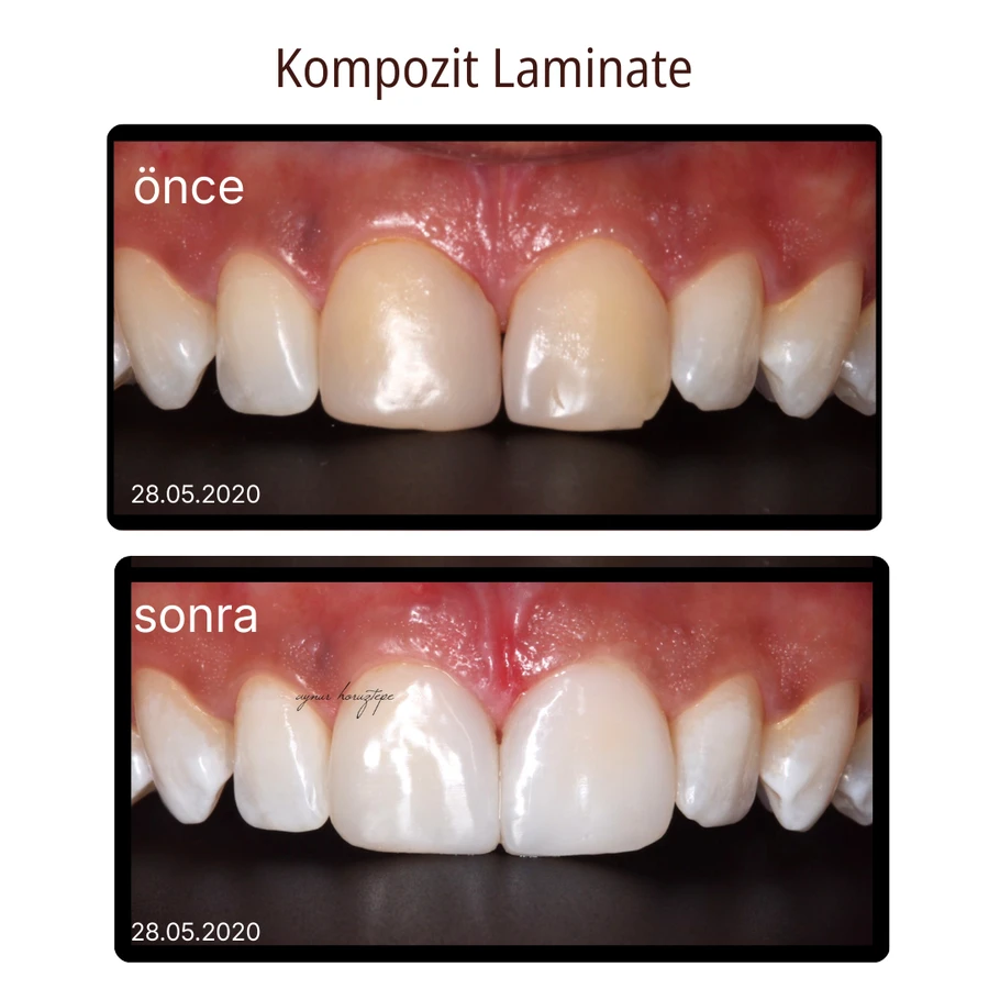 Komposit-Laminat-Veneer Vorher-Nachher Fall 5