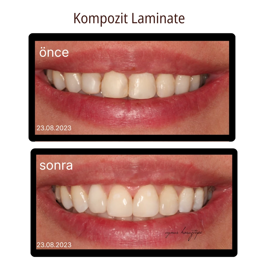Komposit-Laminat-Veneer Vorher-Nachher Fall 8