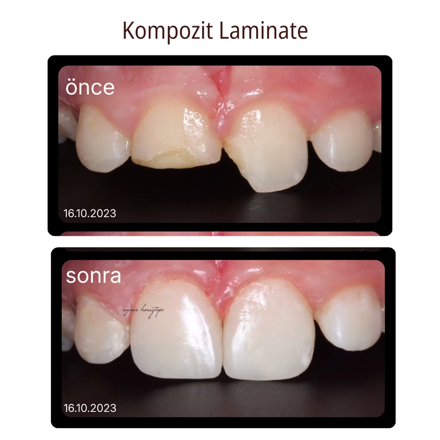 Komposit-Laminat-Veneer Vorher-Nachher Fall 7