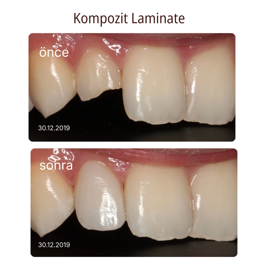 Komposit-Laminat-Veneer Vorher-Nachher Fall 6