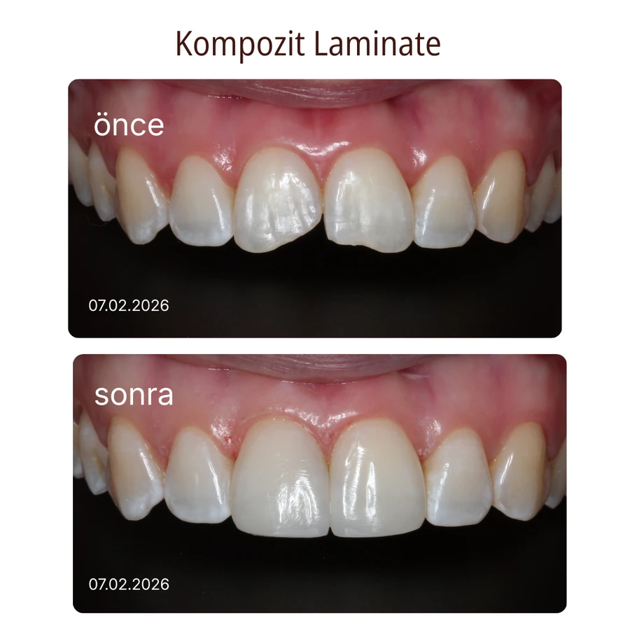 Komposit-Laminat-Veneer Vorher-Nachher Fall 3