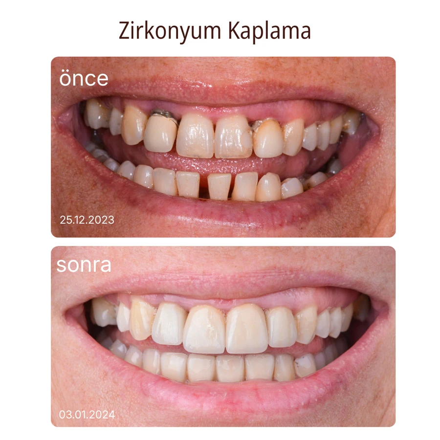 Zirkoniumkrone Vorher-Nachher Fall 6
