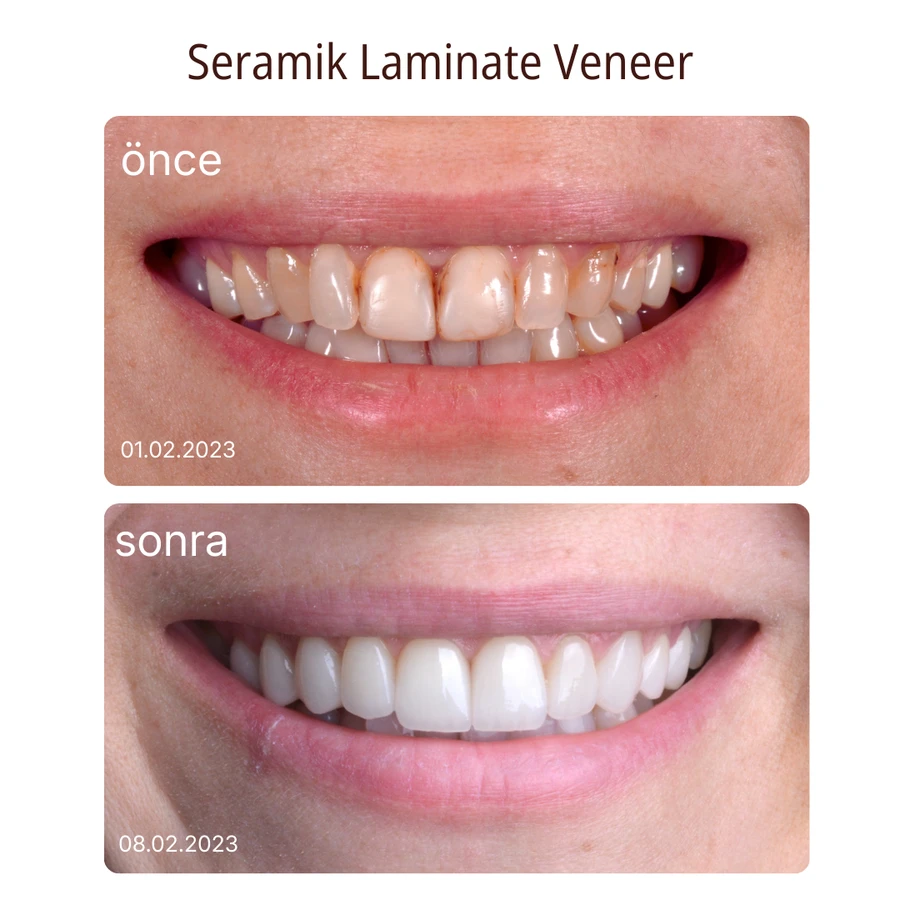 Keramik-Laminat-Veneer Vorher-Nachher Fall 4