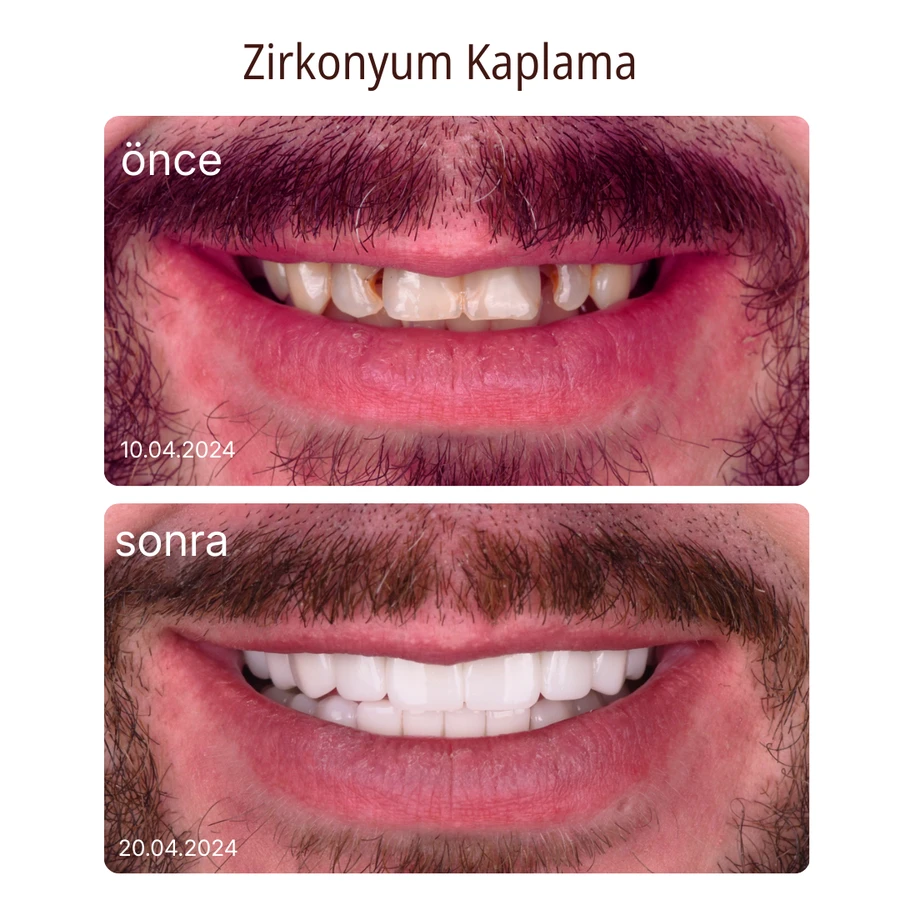 Zirkoniumkrone Vorher-Nachher Fall 1