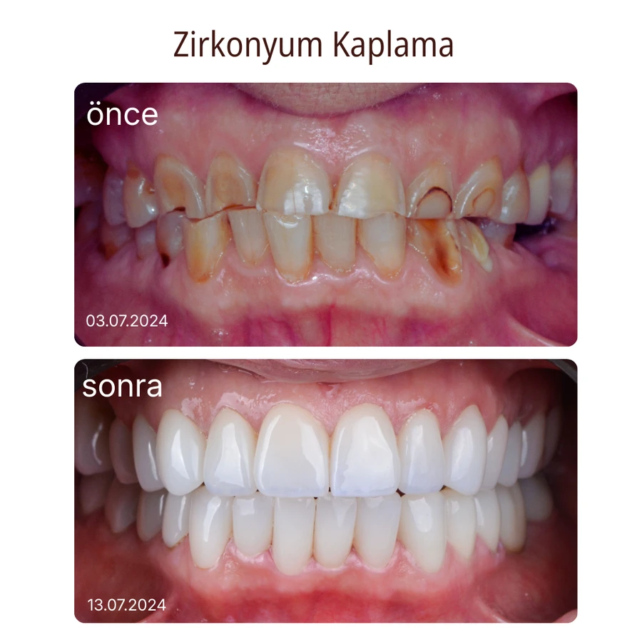 Zirkoniumkrone Vorher-Nachher Fall 2