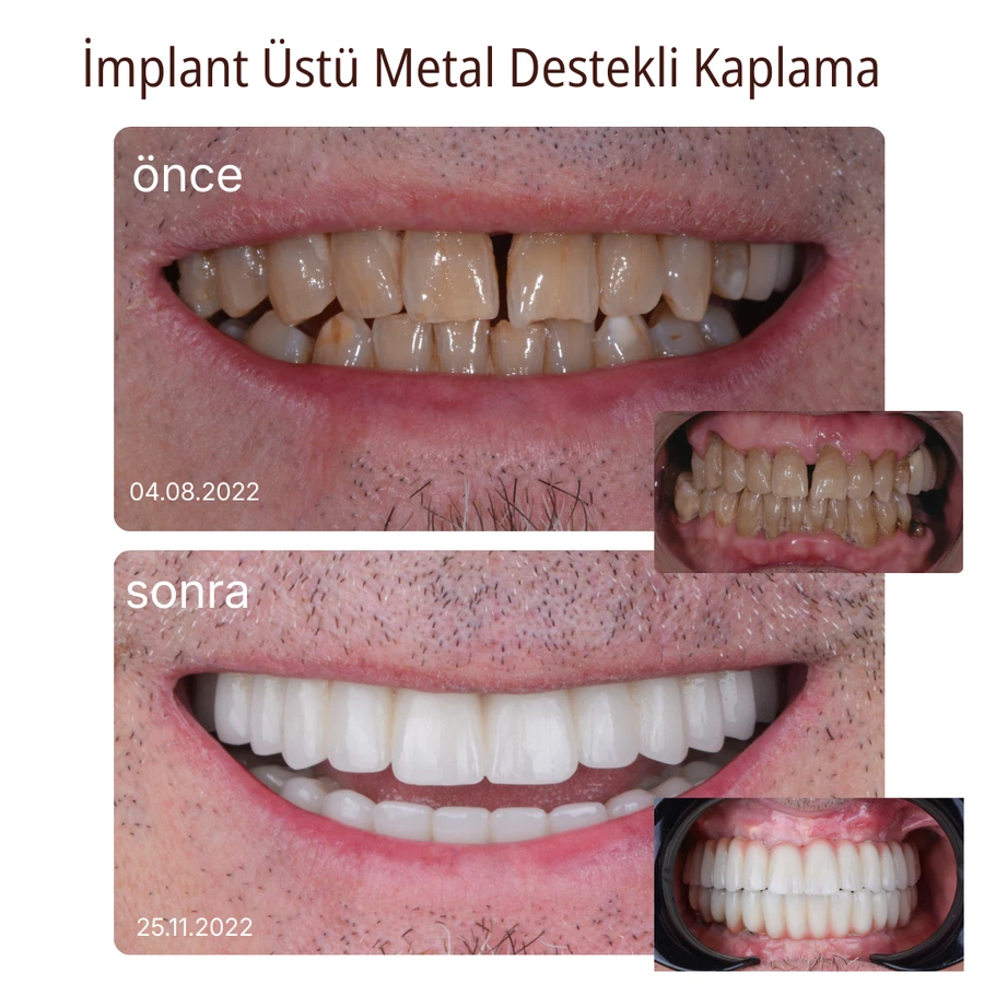 Implantgetragene Versorgung Vorher-Nachher Fall 1