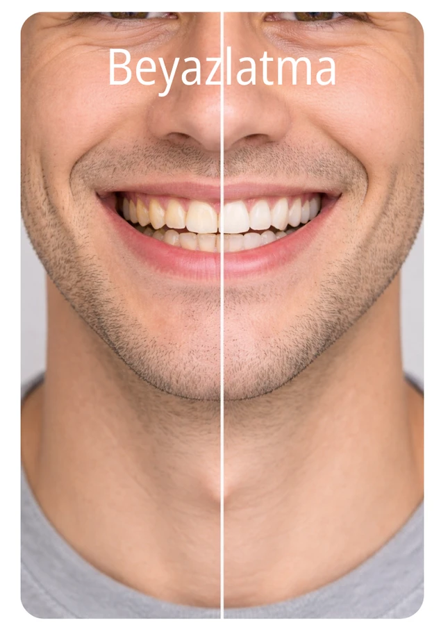 Teeth Whitening (Bleaching) Before & After Smile Transformations