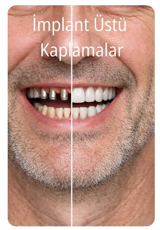 Dental Implant Before & After Smile Transformations
