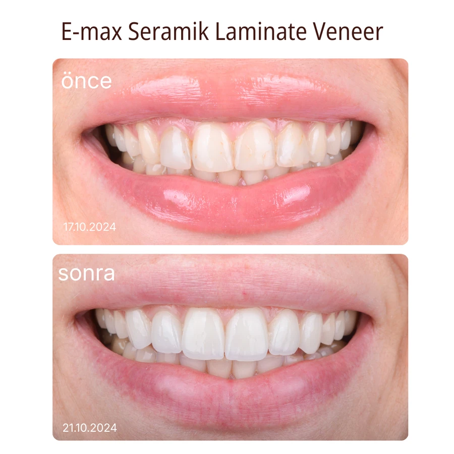 Keramik-Laminat-Veneer Vorher-Nachher Fall 2