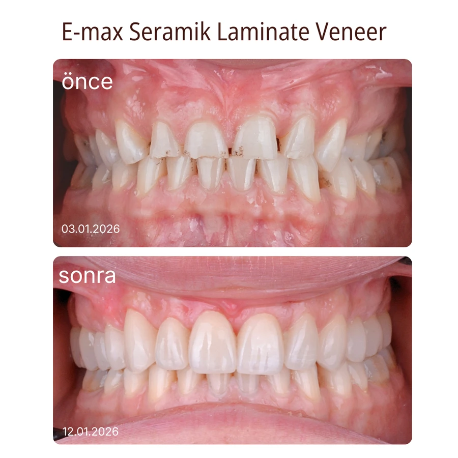 Keramik-Laminat-Veneer Vorher-Nachher Fall 3
