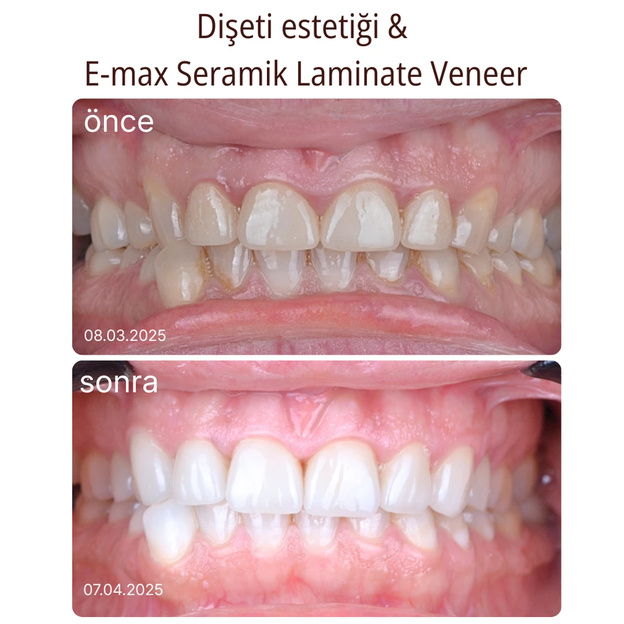 Keramik-Laminat-Veneer Vorher-Nachher Fall 6