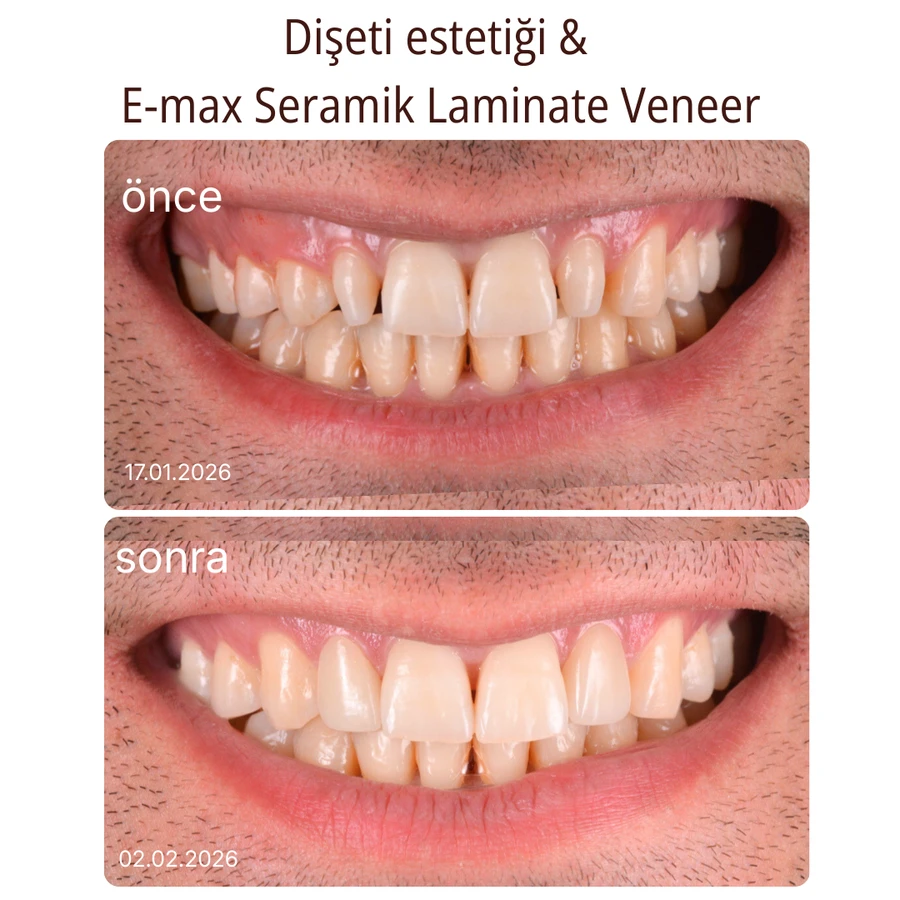 Keramik-Laminat-Veneer Vorher-Nachher Fall 7
