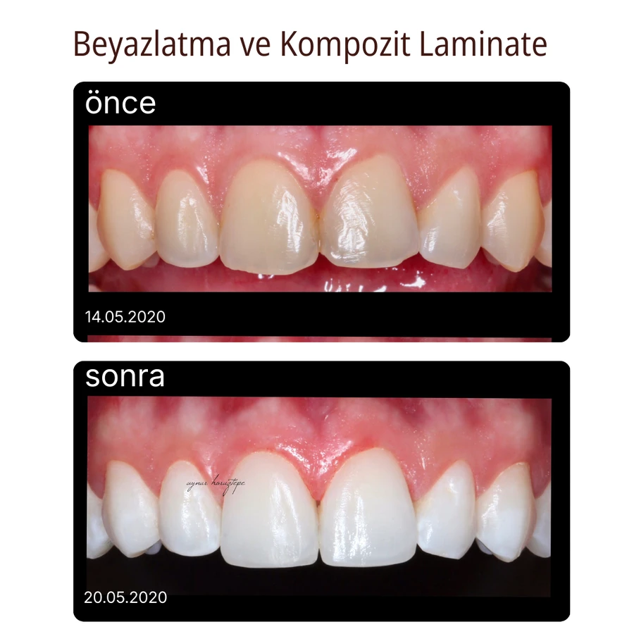 Komposit-Laminat-Veneer Vorher-Nachher Fall 1