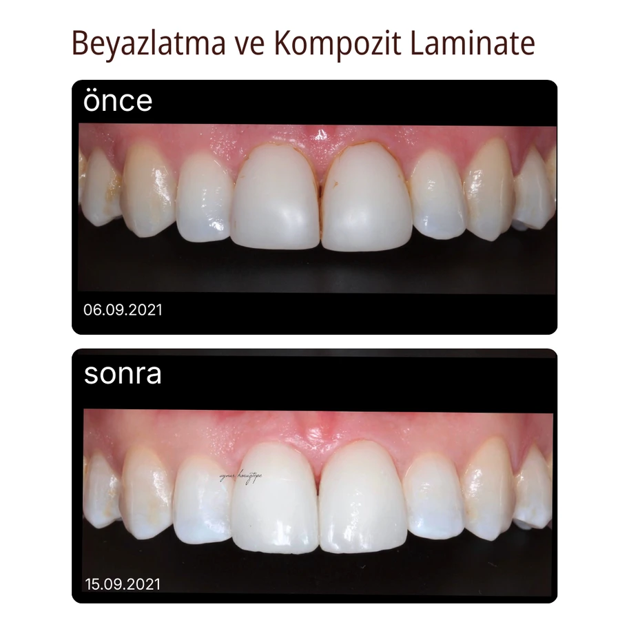 Komposit-Laminat-Veneer Vorher-Nachher Fall 2