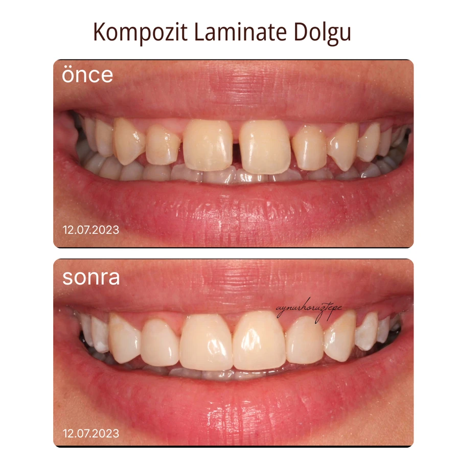 Komposit-Laminat-Veneer Vorher-Nachher Fall 4