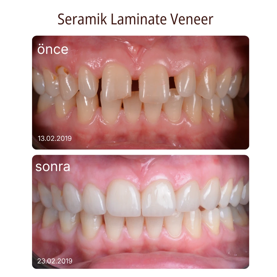 Keramik-Laminat-Veneer Vorher-Nachher Fall 1