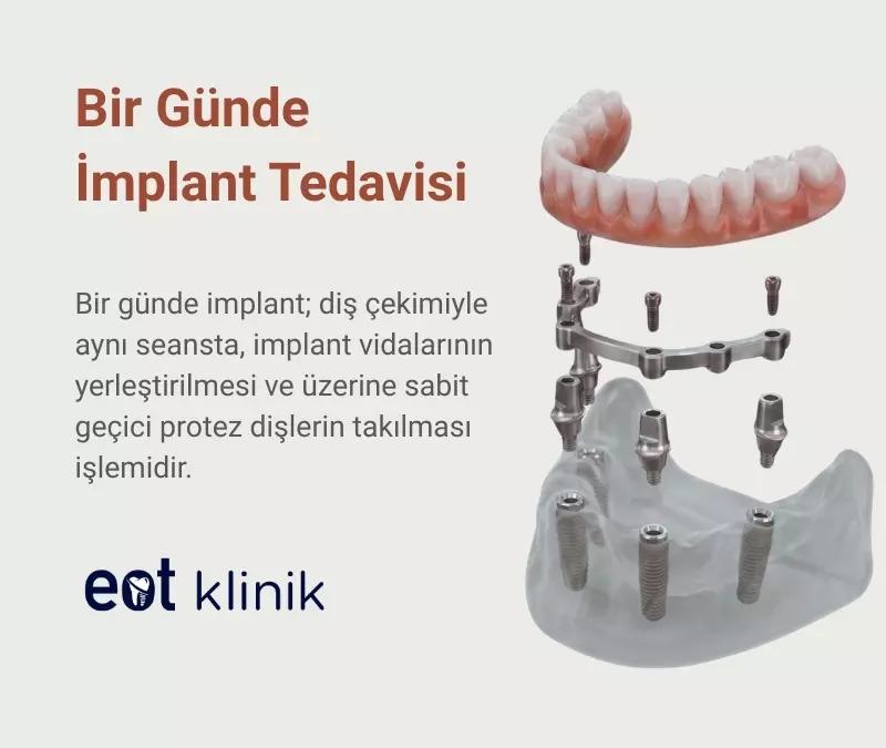 Ankara’da Bir Günde İmplant: Aynı Gün Sabit Dişlere Kavuşun