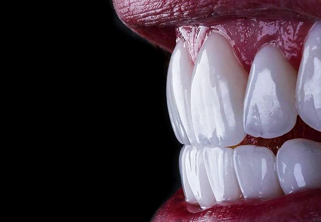 E-max Dental Veneers Ankara