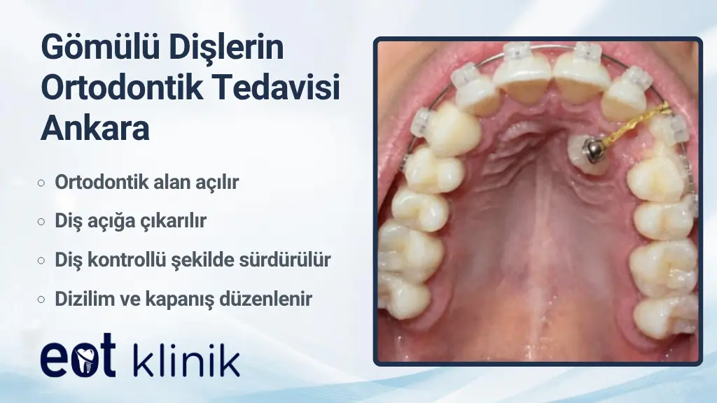 Ankara'da Gömülü Dişlerin Ortodontik Tedavisi ve Gömülü Dişlerin Sürdürülmesi | EOT Klinik Ankara