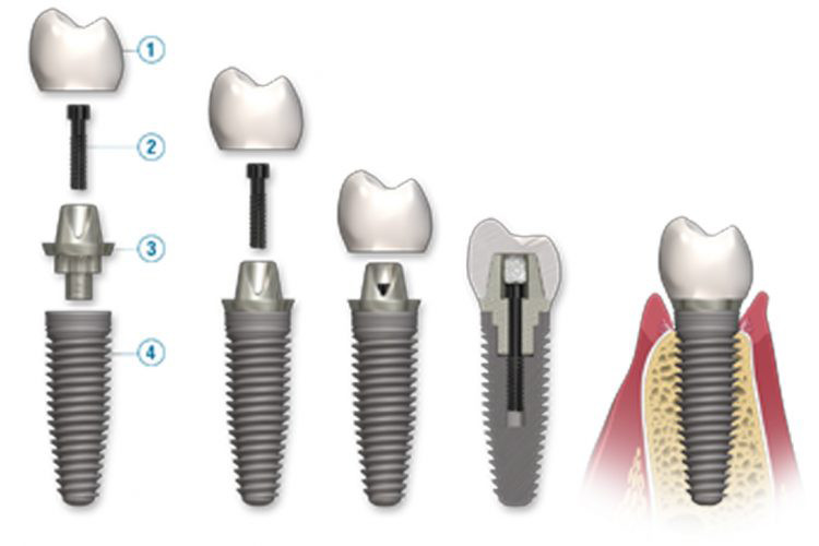implant diş kliniği