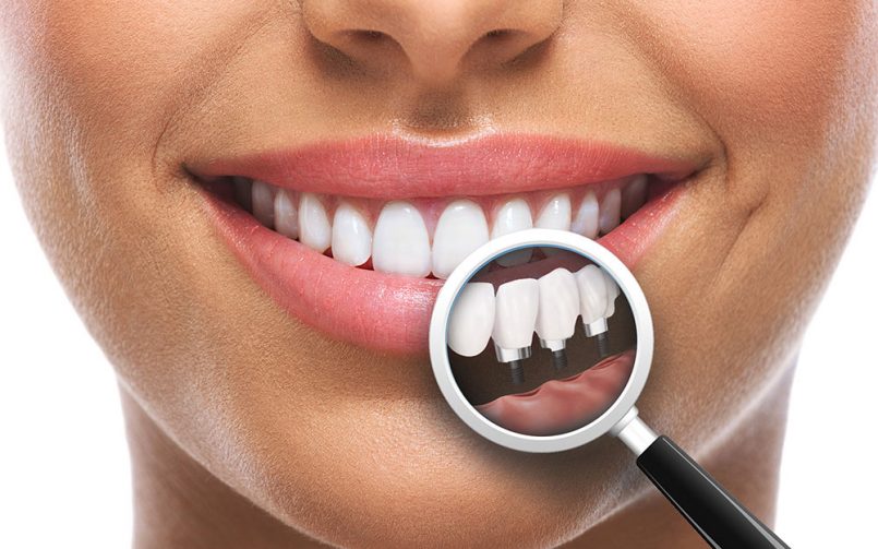 Dental implant yerleştirme ve yükleme zamanları (immediyat)