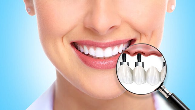 İmplant Tedavisi Ağrılı mıdır?