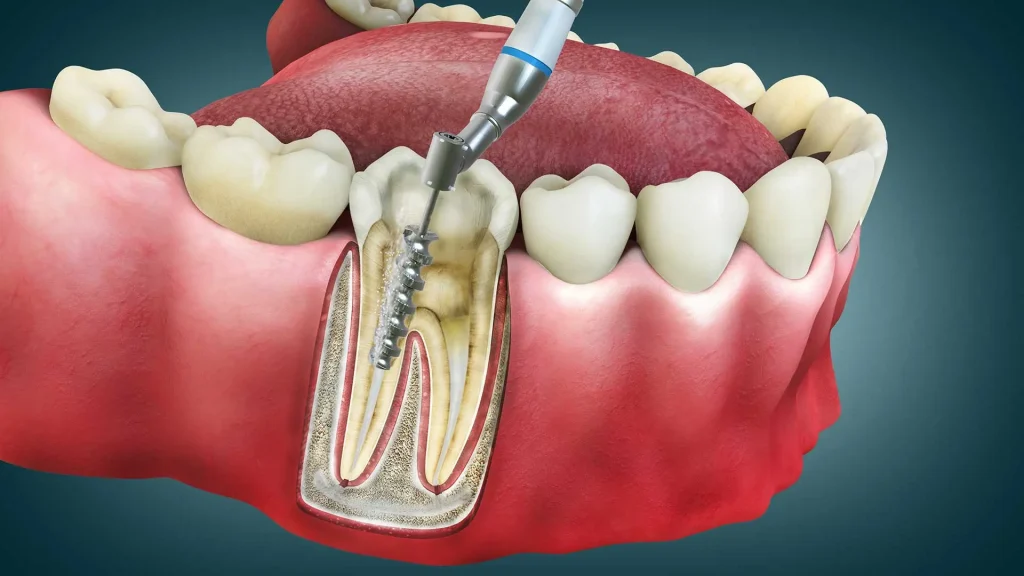 ankara-Endodonti-tedavisi-ve-fiyatlari-202-1024x576