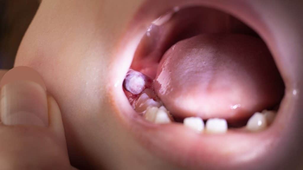 Çene Kistleri ve Tedavisi