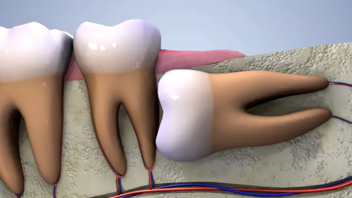 Ankara’da Gömülü Diş Çekimi