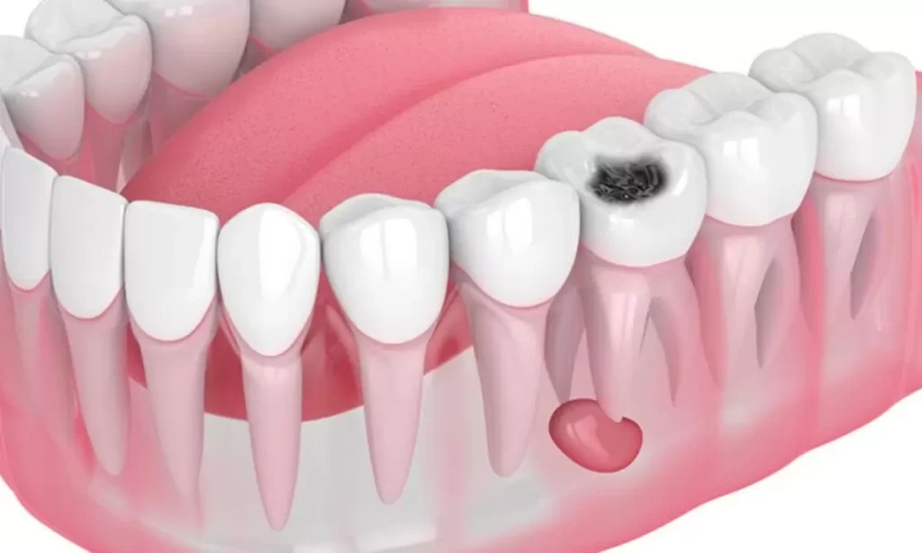 Çene Kistleri ve Tedavisi