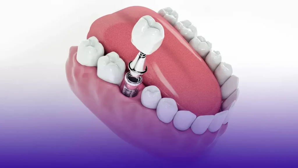 Diş İmplantı Yaptırmak İsteyenler