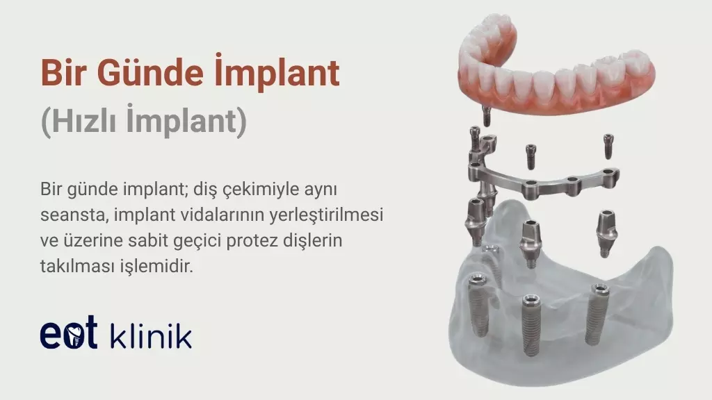 Ankara’da Bir Günde İmplant: Aynı Gün içinde Hızlı Sabit Diş Uygulaması